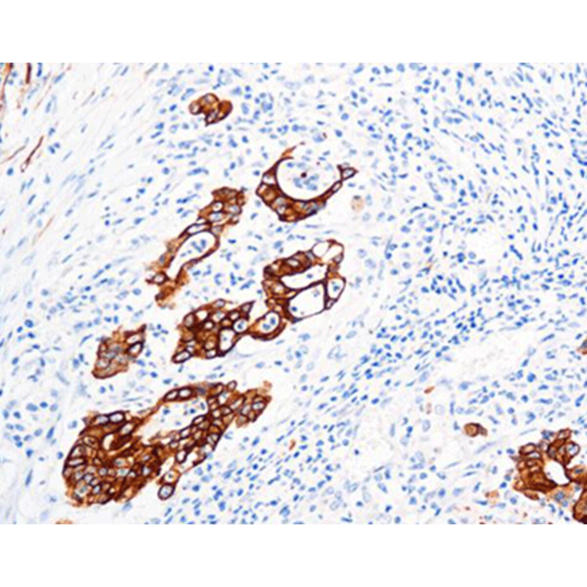 Cytokeratin 19 (CK19)